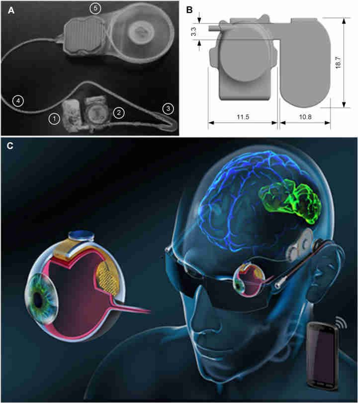 Zdjęcie oraz model 3D implantu Phoenix99. Ostatnia grafika prezentuje pełen obraz protezy. Źródło: Science Direct - Co w człowieku można wymienić na sztuczny zamiennik? - dokument - 2022-04-25