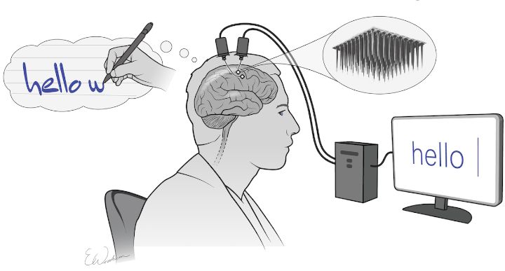 Brain Implant Enables Paralyzed Man to Write Using His Thoughts - picture #1