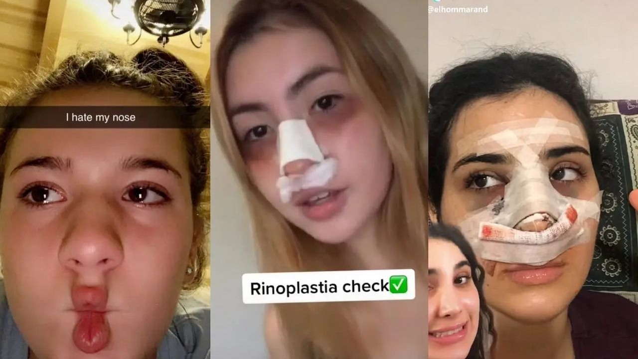 TikTok ma problem - reklamy operacji plastycznych żerują na nastolatkach.